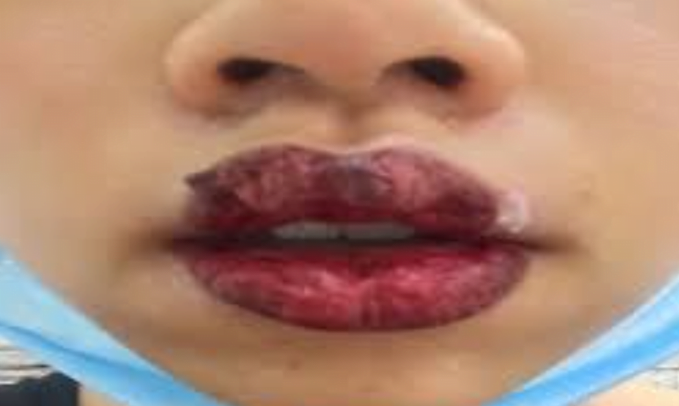 Nhược điểm của phương pháp ủ tê xăm truyền thống